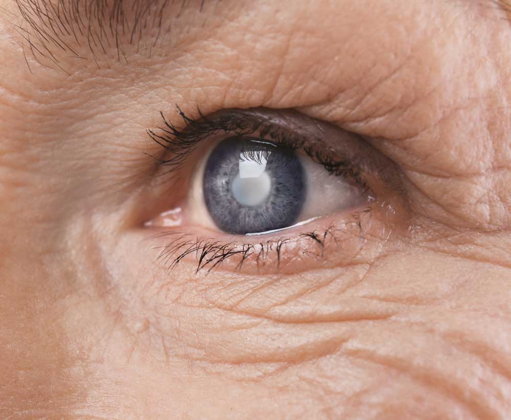 Cannabis and Eye Problems